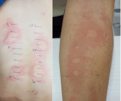 Pruebas de alergia positivas