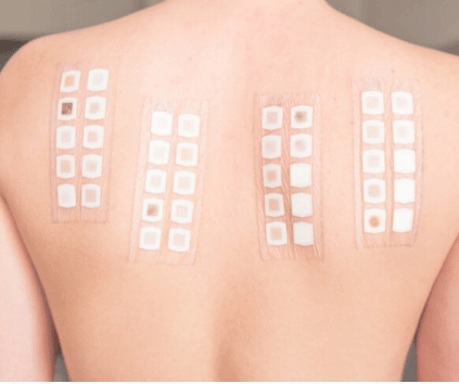 Prueba de parche patch test aplicada en espalda de paciente para diagnóstico de alergia por contacto en consultorio alergólogo Monterrey NL
